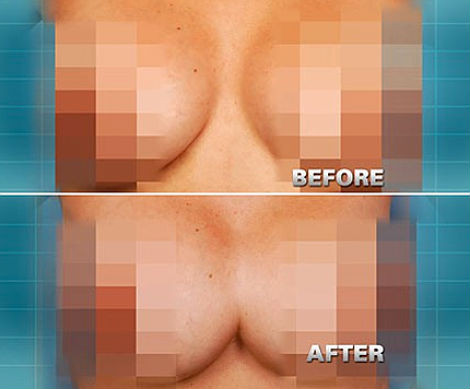 Vòng một của Dinora Rodriguez trước và sau khi phẫu thuật Vòng một của Dinora Rodriguez trước và sau khi phẫu thuật