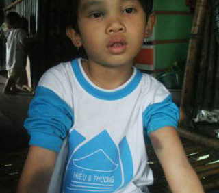 Những vết bầm tím trên trán và tay cháu Ngân Những vết bầm tím trên trán và tay cháu Ngân