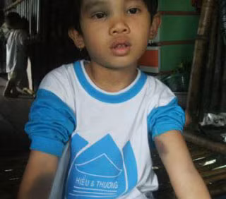 Những vết bầm tím trên trán và tay cháu Ngân