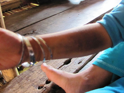 Vết bầm tím trên tay bé Ngân Vết bầm tím trên tay bé Ngân