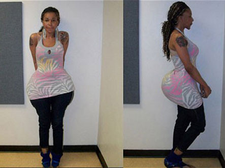 Suýt chết vì nâng cấp vòng 3 bằng... xi măng và keo ảnh 1 Bác sĩ "rởm" cũng có vòng ba quá khổ