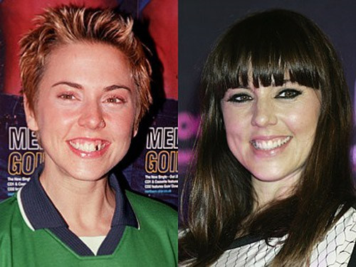 Cựu ca sĩ của ban nhạc nổi tiếng nước Anh Spice Girl - Mel C từng bị bình chọn là Sao sở hữu hàm răng tồi tệ nhất. Tuy nhiên vài năm sau người hâm mộ lại thấy Mel C có một hàm răng đẹp hơn nhiều. Cựu ca sĩ của ban nhạc nổi tiếng nước Anh Spice Girl - Mel C từng bị bình chọn là Sao sở hữu hàm răng tồi tệ nhất. Tuy nhiên vài năm sau người hâm mộ lại thấy Mel C có một hàm răng đẹp hơn nhiều.