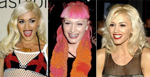 Gwen Stefani phải mất một thời gian khá dài để có hàm răng như ý Xem thêm: Ngắm Sao Việt thuở còn..."răng sữa"/Scarlett Johansson "mất điểm" vì hàm răng ố vàng và mập ú/Thảm họa thẩm mỹ của Sao Gwen Stefani phải mất một thời gian khá dài để có hàm răng như ý Xem thêm: Ngắm Sao Việt thuở còn..."răng sữa"/Scarlett Johansson "mất điểm" vì hàm răng ố vàng và mập ú/Thảm họa thẩm mỹ của Sao