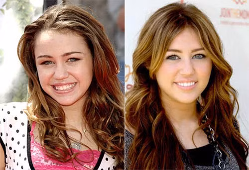 Khi trở thành ngôi sao trẻ của Hollywood thì đương nhiên sẽ nhận được nhiều quan tâm chú ý của công chúng. Đây chính là lý do tại sao Miley Cyrus lại phải đi chỉnh sửa hàm răng của mình