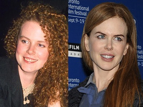 Nicole Kidman là ngôi sao không chỉ chỉnh sửa răng mà cô còn thẩm mỹ môi, bơm botox làm căng da mặt. Xem thêm: Ngắm Sao Việt thuở còn..."răng sữa"/Scarlett Johansson "mất điểm" vì hàm răng ố vàng và mập ú/Thảm họa thẩm mỹ của Sao Nicole Kidman là ngôi sao không chỉ chỉnh sửa răng mà cô còn thẩm mỹ môi, bơm botox làm căng da mặt. Xem thêm: Ngắm Sao Việt thuở còn..."răng sữa"/Scarlett Johansson "mất điểm" vì hàm răng ố vàng và mập ú/Thảm họa thẩm mỹ của Sao