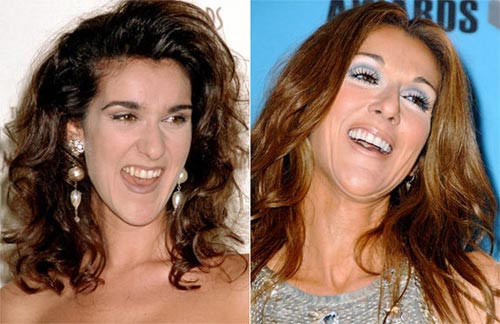 Trước đây, Celine Dion sở hữu hàm răng vàng, không đều đặn Xem thêm: Ngắm Sao Việt thuở còn..."răng sữa"/Scarlett Johansson "mất điểm" vì hàm răng ố vàng và mập ú/Thảm họa thẩm mỹ của Sao Trước đây, Celine Dion sở hữu hàm răng vàng, không đều đặn Xem thêm: Ngắm Sao Việt thuở còn..."răng sữa"/Scarlett Johansson "mất điểm" vì hàm răng ố vàng và mập ú/Thảm họa thẩm mỹ của Sao