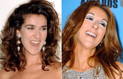 Trước đây, Celine Dion sở hữu hàm răng vàng, không đều đặn Xem thêm: Ngắm Sao Việt thuở còn..."răng sữa"/Scarlett Johansson "mất điểm" vì hàm răng ố vàng và mập ú/Thảm họa thẩm mỹ của Sao