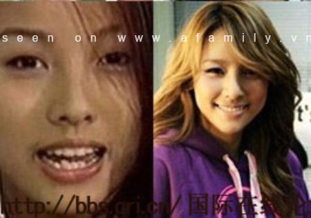 Nữ hoàng gợi cảm Lee Hyori cũng chẳng may mắn khi có 1 hàm răng cái nhô ra, cái thụt vào. Rồi cô quyết định đến thẩm mỹ răng hàm mặt để “đổi đời” cho hàm răng, và đó quả là một quyết định sáng suốt! Ảnh: Afamily Nữ hoàng gợi cảm Lee Hyori cũng chẳng may mắn khi có 1 hàm răng cái nhô ra, cái thụt vào. Rồi cô quyết định đến thẩm mỹ răng hàm mặt để “đổi đời” cho hàm răng, và đó quả là một quyết định sáng suốt! Ảnh: Afamily