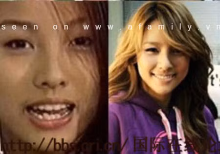 Nữ hoàng gợi cảm Lee Hyori cũng chẳng may mắn khi có 1 hàm răng cái nhô ra, cái thụt vào. Rồi cô quyết định đến thẩm mỹ răng hàm mặt để “đổi đời” cho hàm răng, và đó quả là một quyết định sáng suốt! Ảnh: Afamily