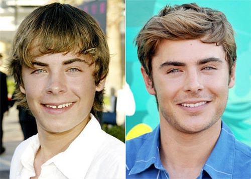 Ngôi sao trẻ Zac Efron có thể làm rung động hàng triệu trái tim thiếu nữ trên toàn thế giới bằng vẻ đẹp trai và nụ cười tươi sáng, nhưng trước đây cậu cũng từng sở hữu hàm răng vàng, thưa và không đều đặn. Ngôi sao trẻ Zac Efron có thể làm rung động hàng triệu trái tim thiếu nữ trên toàn thế giới bằng vẻ đẹp trai và nụ cười tươi sáng, nhưng trước đây cậu cũng từng sở hữu hàm răng vàng, thưa và không đều đặn.
