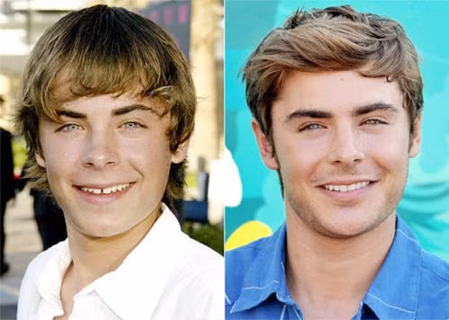 Ngôi sao trẻ Zac Efron có thể làm rung động hàng triệu trái tim thiếu nữ trên toàn thế giới bằng vẻ đẹp trai và nụ cười tươi sáng, nhưng trước đây cậu cũng từng sở hữu hàm răng vàng, thưa và không đều đặn.