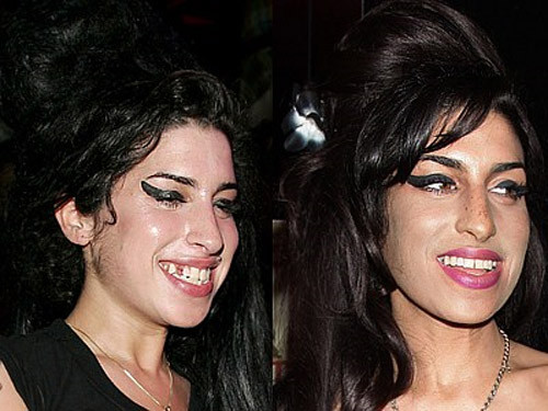 Amy Winehouse đã từng bị mất một chiếc răng và nhờ nha khoa thẩm mỹ cô đã có hàm răng hoàn chỉnh. Chùm ảnh: 2sao Amy Winehouse đã từng bị mất một chiếc răng và nhờ nha khoa thẩm mỹ cô đã có hàm răng hoàn chỉnh. Chùm ảnh: 2sao