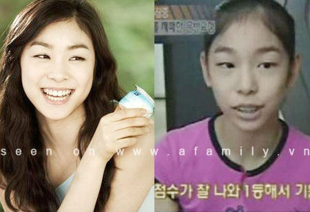 Từ khi sinh ra, “Nữ hoàng sân băng” nổi tiếng xứ Hàn - Kim Yuna đã sở hữu 1 hàm răng "vẩu" và không mấy thẩm mỹ. Tuy nhiên khi trở thành người nổi tiếng, Yuna đã phải nhờ đến công nghệ chỉnh sửa hiện đại để có được nụ cười tươi tắn như hiện nay. Ảnh: Afamily Từ khi sinh ra, “Nữ hoàng sân băng” nổi tiếng xứ Hàn - Kim Yuna đã sở hữu 1 hàm răng "vẩu" và không mấy thẩm mỹ. Tuy nhiên khi trở thành người nổi tiếng, Yuna đã phải nhờ đến công nghệ chỉnh sửa hiện đại để có được nụ cười tươi tắn như hiện nay. Ảnh: Afamily