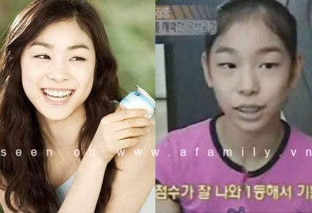 Từ khi sinh ra, “Nữ hoàng sân băng” nổi tiếng xứ Hàn - Kim Yuna đã sở hữu 1 hàm răng "vẩu" và không mấy thẩm mỹ. Tuy nhiên khi trở thành người nổi tiếng, Yuna đã phải nhờ đến công nghệ chỉnh sửa hiện đại để có được nụ cười tươi tắn như hiện nay. Ảnh: Afamily