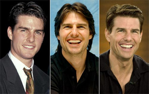 Tom Cruise phải nhờ đến bác sĩ chỉnh răng để có nụ cười đẹp hơn Xem thêm: Ngắm Sao Việt thuở còn..."răng sữa"/Scarlett Johansson "mất điểm" vì hàm răng ố vàng và mập ú/Thảm họa thẩm mỹ của Sao Tom Cruise phải nhờ đến bác sĩ chỉnh răng để có nụ cười đẹp hơn Xem thêm: Ngắm Sao Việt thuở còn..."răng sữa"/Scarlett Johansson "mất điểm" vì hàm răng ố vàng và mập ú/Thảm họa thẩm mỹ của Sao