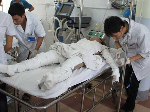 Nạn nhân bị bỏng nặng (Ảnh Nguoi lao dong) Nạn nhân bị bỏng nặng (Ảnh Nguoi lao dong)
