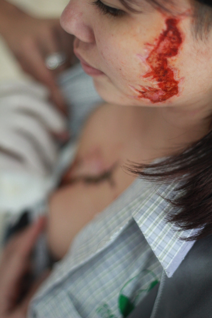 Vết xăm rết trên ngực G sâu gần 2mm