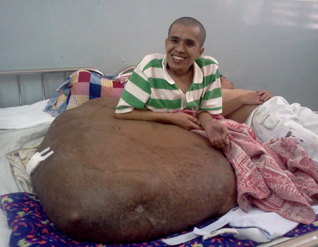 Anh Nguyễn Duy Hải mong được mổ khối u khổng lồ. Ảnh: Thiên Chương.