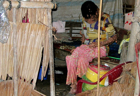 Chị Sa Ly với hàng nghìn mụn thịt trên người. Ảnh: Thiên Phước.