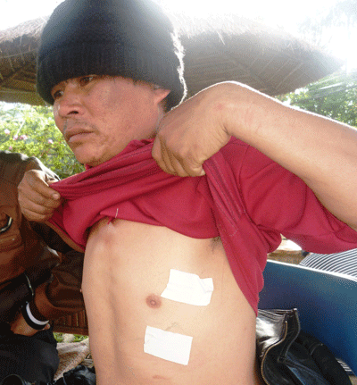 Ông Phong bị chủ tịch UBND xã Xuân Trường đánh chấn thương ở đầu, ngực, bụng. Ảnh: Người Lao Động Online Ông Phong bị chủ tịch UBND xã Xuân Trường đánh chấn thương ở đầu, ngực, bụng. Ảnh: Người Lao Động Online