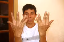 Chuyện lạ: Hàng trăm người mọc thêm ngón tay, chân