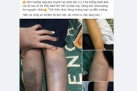 Quận Sơn Trà: Xác minh vụ việc học sinh tiểu học bị đánh bầm tím trên lớp