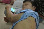 Hà Nội: Bé 10 tuổi bị cha đẻ dùng xích, roi sắt hành hạ