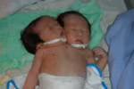 Bé gái sơ sinh có hai đầu, hai cổ ở Sóc Trăng