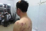 Hà Nội: Bị côn đồ tra tấn suốt 3 giờ trong đêm mưa