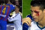 Ronaldo đổ máu vì đòn cùi chỏ