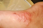 "Khám" bệnh nhân "giun bò lổm nhổm dưới da" ở Hà Nội