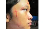 Một phụ huynh đánh nữ sinh lớp 8 phải cấp cứu