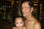 Đời bi thảm của thợ săn bị gấu móc mắt, lột da