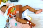 Bệnh nhi 21 tháng bị tổn thương nặng bàng quang do sai sót của bác sĩ