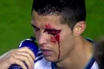 Rách mí mắt, thị lực giảm, Ronaldo nghỉ thi đấu