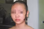 Cô gái bị xăm rết lên mặt bị hư tổn da sâu gần 2mm
