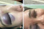 Nghi do mâu thuẫn tình cảm, nam sinh lớp 10 bị bạn đánh nứt xương trán