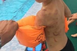 Học sinh lớp 3 bị bố đánh chi chít vết thương ở lưng