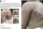 Nghệ An: Tạm đình chỉ 15 ngày với giáo viên dùng thước đánh học sinh thâm tím