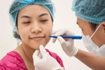 Tạo má lúm: Chưa thấy duyên đã gặp họa