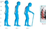 Giải đáp những câu hỏi cần thiết nhất về sức khỏe của xương