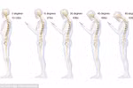 Sử dụng điện thoại không đúng cách dễ mắc đau cột sống