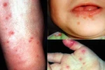 Ðiểm mặt virut gây bệnh nguy hiểm ở trẻ em