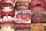 Những sai lầm thường gặp khi mắc bệnh sâu răng