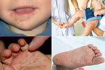 Vì sao bé mắc bệnh Tay-Chân-Miệng?