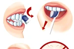 Điều trị mòn răng khó hay dễ?