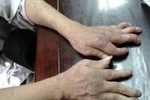 Người bị stress dễ phát bệnh vảy nến 