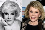 Sao bất ngờ "đơ" như đá vì tiêm botox