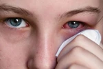 Ngắm mắt có thể đoán ra bệnh: ung thư, gan, đột qụy,..? 