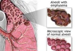 Liệu pháp tế bào thân sẽ giúp phục hồi mô phổi